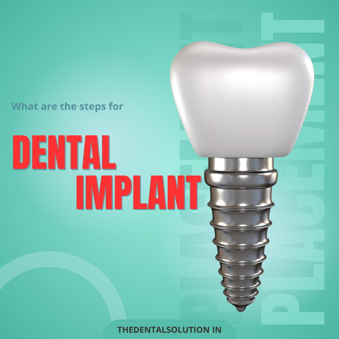 DENTAL IMPLANT