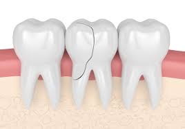 MOLAR TOOTH